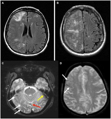 Risk factors in developing amyloid related imaging abnormalities (ARIA) and clinical implications